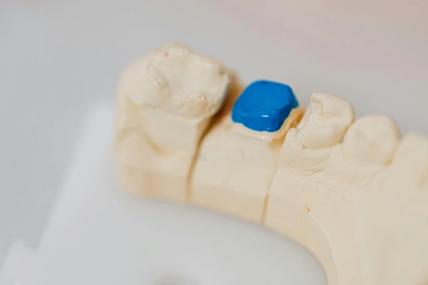 Dental Fillings