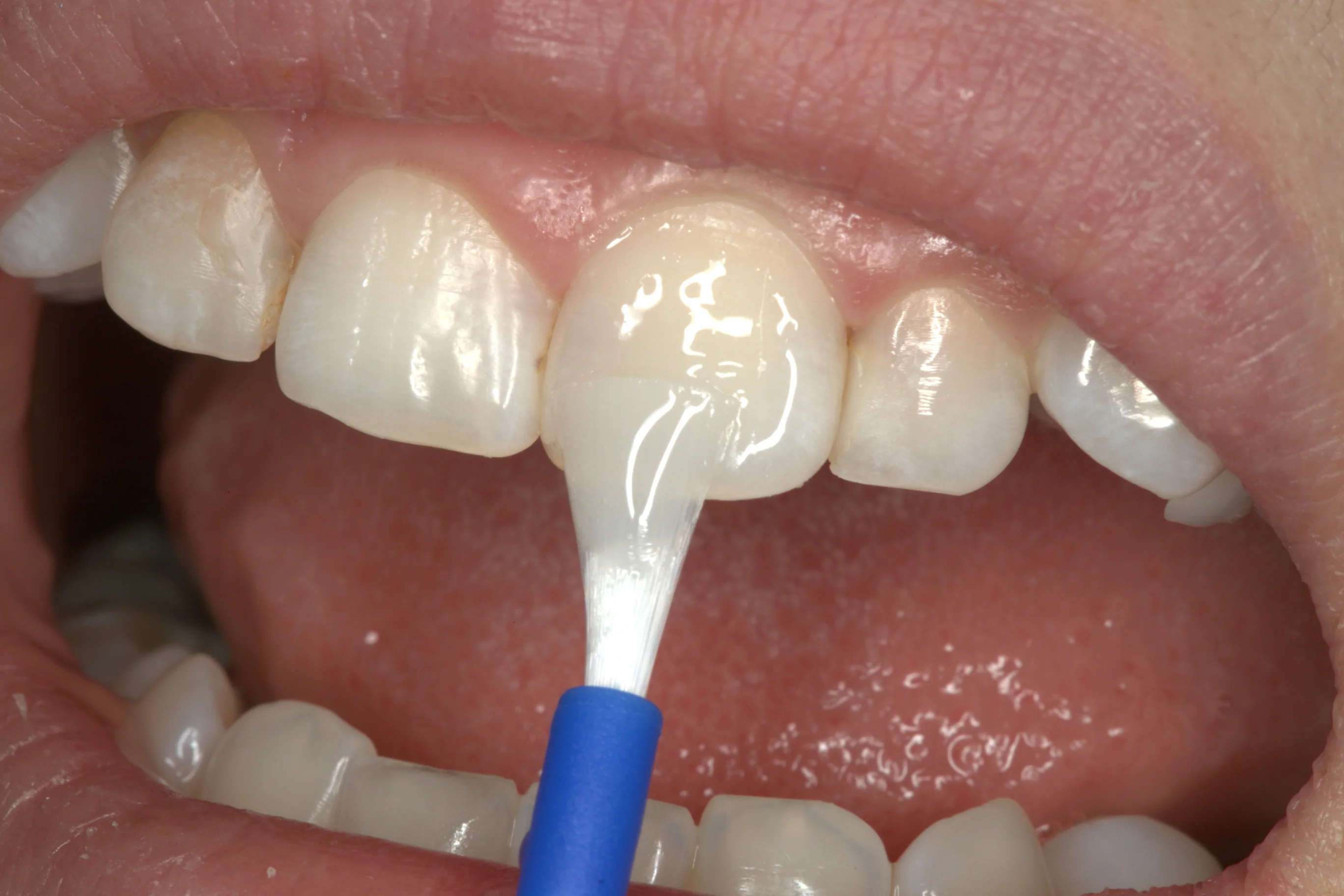 Fluoride Treatment