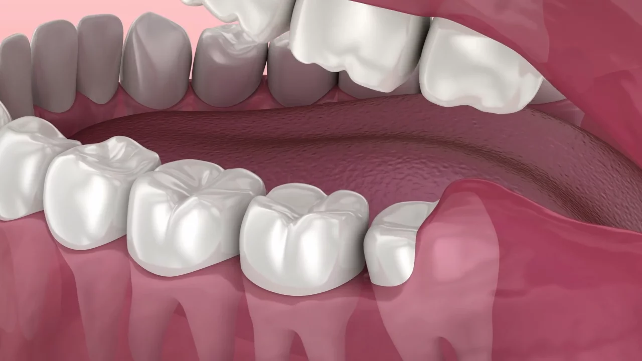 Wisdom Tooth Removal